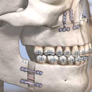 جراحی فک (ارتوگناتیک)