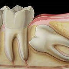 جراحی دندان های نهفته (دندان عقل)